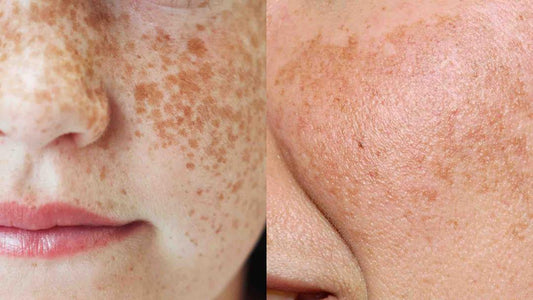 Pigmentflekker i ansiktet før og etter behandling med koreansk hudpleie