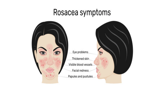 Rosacea: Hvordan roe ned sensitiv hud og styrke barrieren din